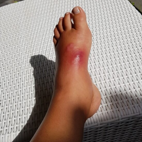 muggen bulten ontstoken voet bali